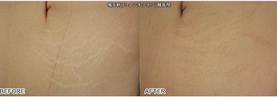 A before and after photo of a woman 's stomach with stretch marks.