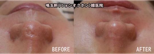 A before and after photo of a woman 's face
