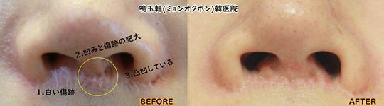 A before and after picture of a person 's nose