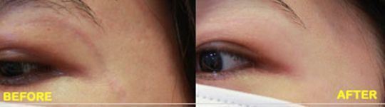A before and after picture of a woman 's eye