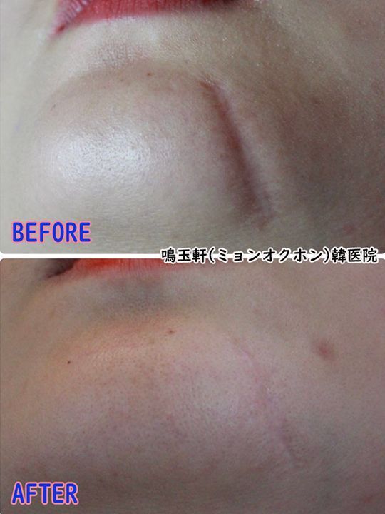 A before and after photo of a woman 's face with a scar.