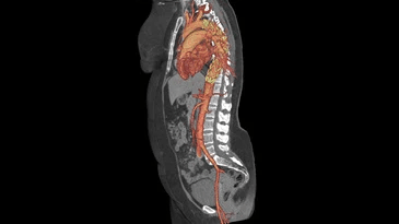 A ct scan of a person 's chest and abdomen showing the heart and arteries.