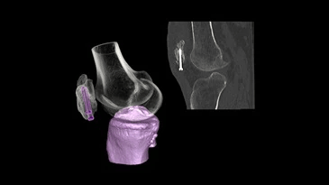 A ct scan of a knee with a screw in it.