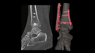 A ct scan of a person 's ankle with a broken bone.