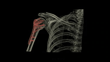 An x-ray of a person 's shoulder with a broken bone.