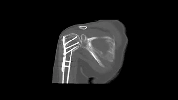 A ct scan of a person 's shoulder with a screw in it.