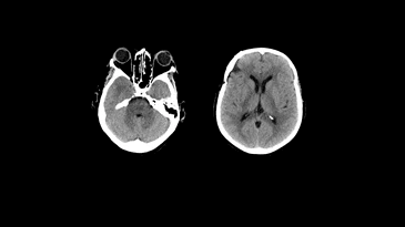 A black and white ct scan of a person 's brain.
