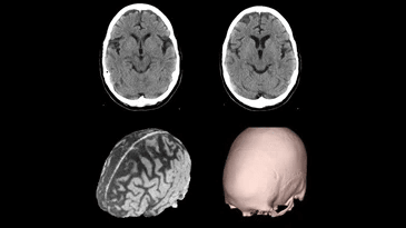 A ct scan of a brain and a skull on a black background.