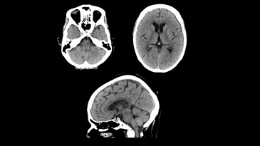 A black and white image of a brain on a black background.