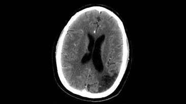 A black and white ct scan of a person 's brain.