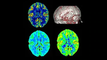 Four different images of a brain are shown on a black background.