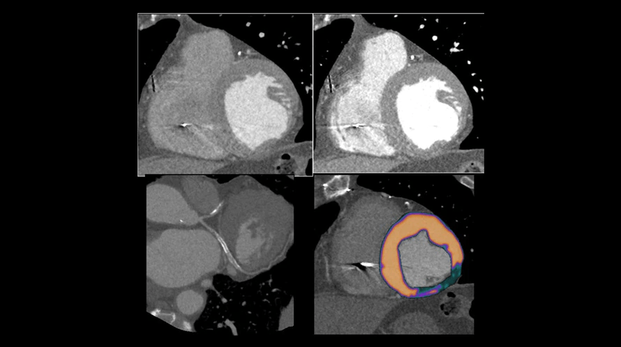 A collage of four ct images of a heart.