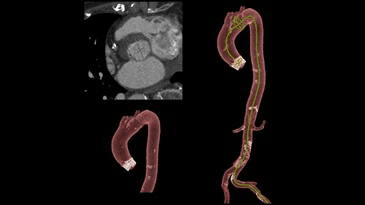 A ct scan of a heart and a ct scan of an aorta.