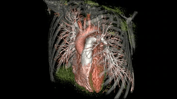 A 3d ct scan of a person 's heart and chest.