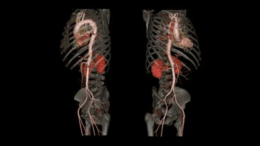 A 3d ct scan of a person 's chest and abdomen showing the aorta and kidneys.