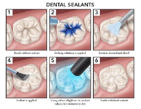 Dental Sealants Dr. Jim Ney