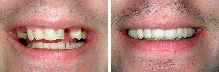 Before and After Dental implant procedure.