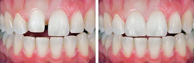 Before and After Porcelain Veneers