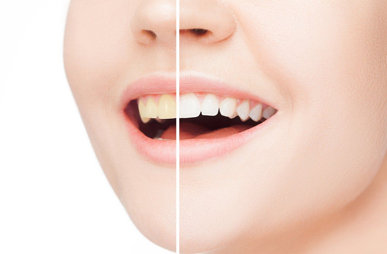 professional teeth whitening results on woman smiling