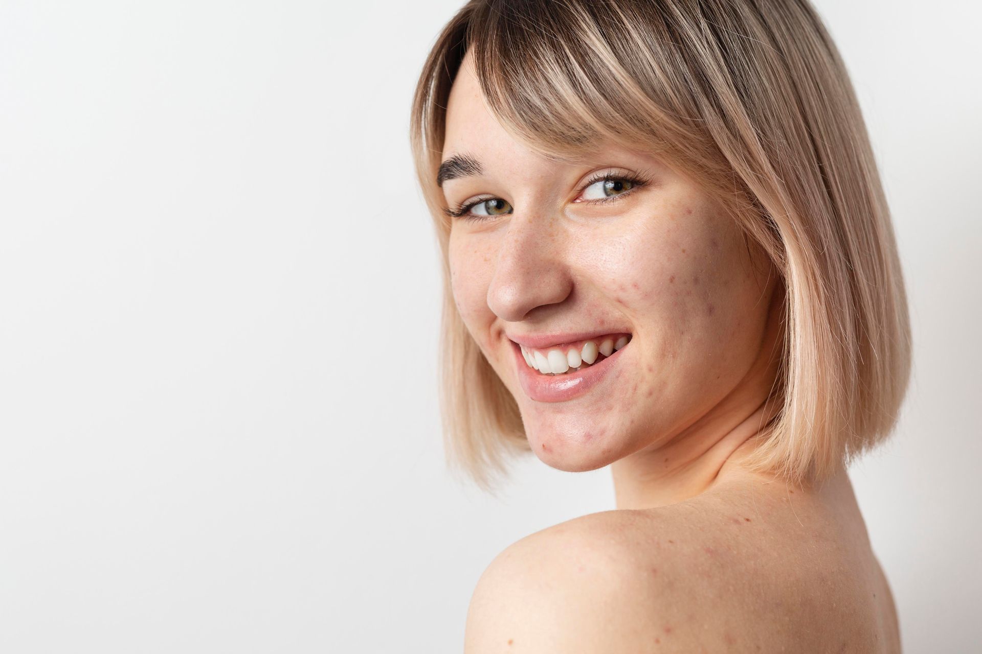 A woman with acne on her face is smiling and looking over her shoulder.