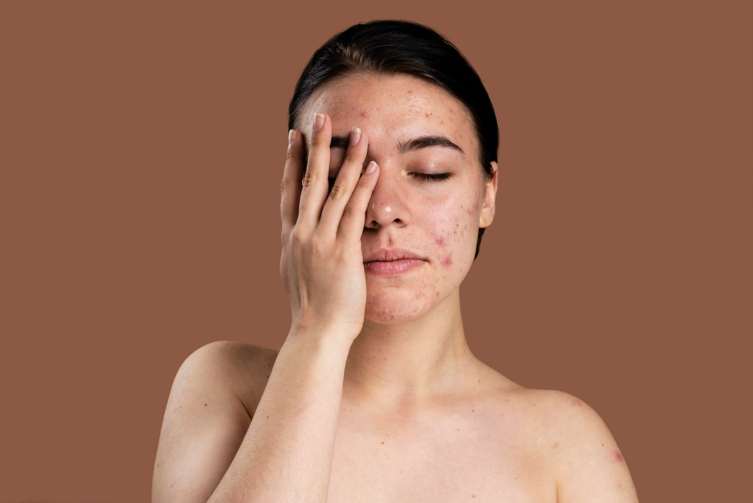 Woman with acne covering her face, shielding eyes with hand, brown background.
