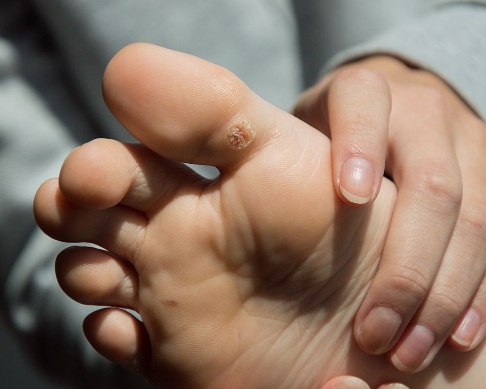 Warts