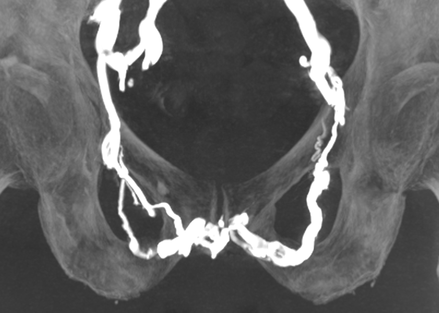 Dysfonction érectile veineuse  une pathologie méconnue mais fréquente