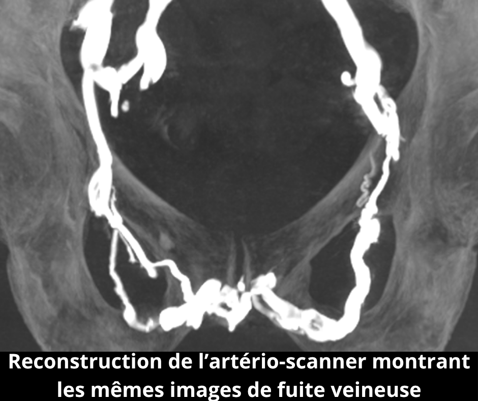 Unité de Radiologie Interventionnelle Avancée - Pitié-Salpêtrière - APHP Sorbonne Université Dysfonction érectile veineuse une pathologie méconnue mais fréquente 2