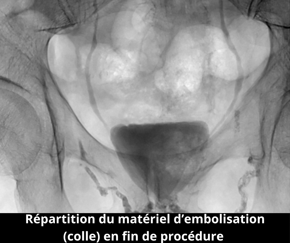 Unité de Radiologie Interventionnelle Avancée - Pitié-Salpêtrière - APHP Sorbonne Université Dysfonction érectile veineuse une pathologie méconnue mais fréquente 3