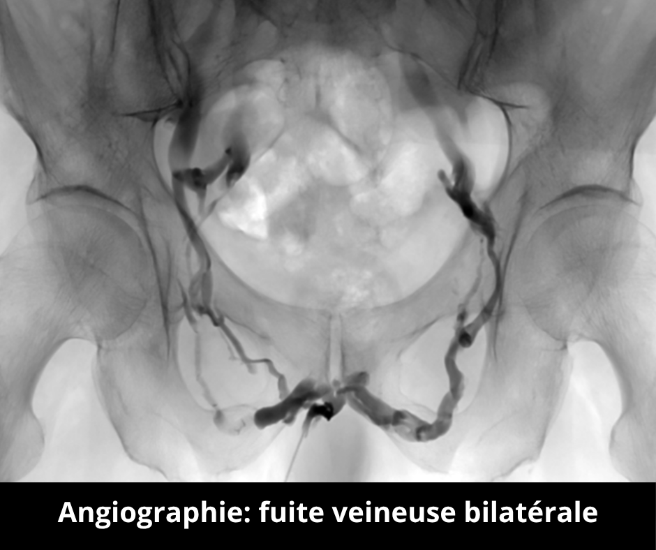 Unité de Radiologie Interventionnelle Avancée - Pitié-Salpêtrière - APHP Sorbonne Université Dysfonction érectile veineuse une pathologie méconnue mais fréquente