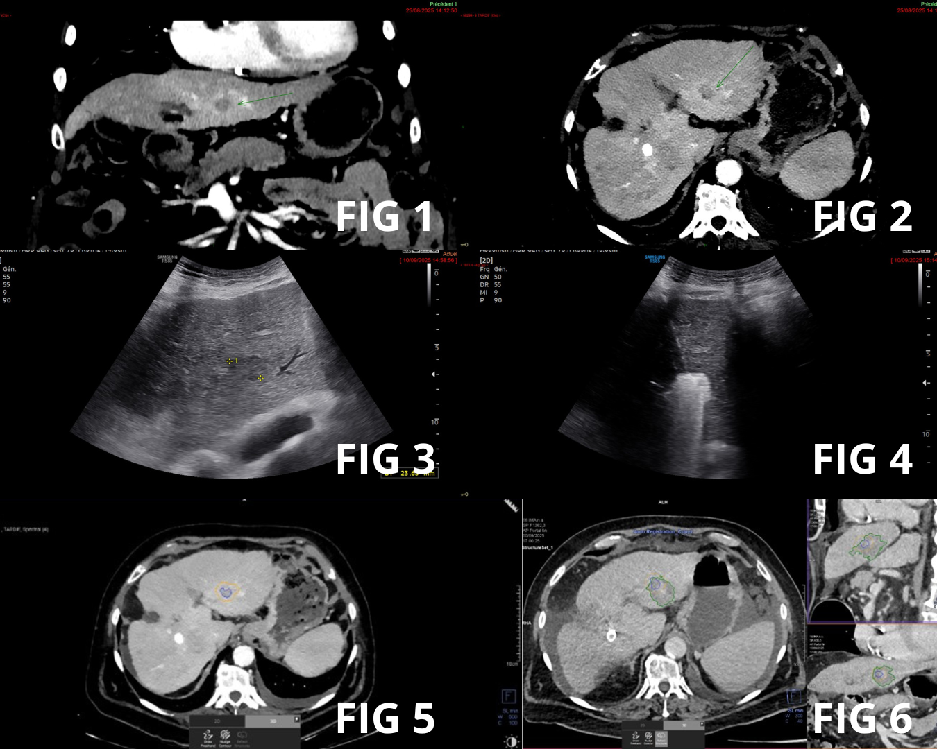 Varian Siemens Healthineers hepatic microwave ablation system