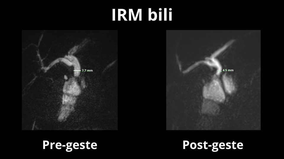 service radiologie interventionnelle pitie salpertriere traitement sténose biliaire bénigne