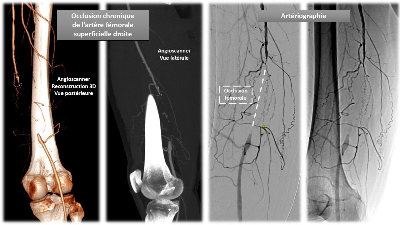 L'artériopathie oblitérante des membres inférieurs