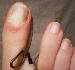 tecnica della rieducazione ungueale