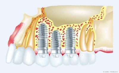 Implantate ersetzen fehlende Zähne.