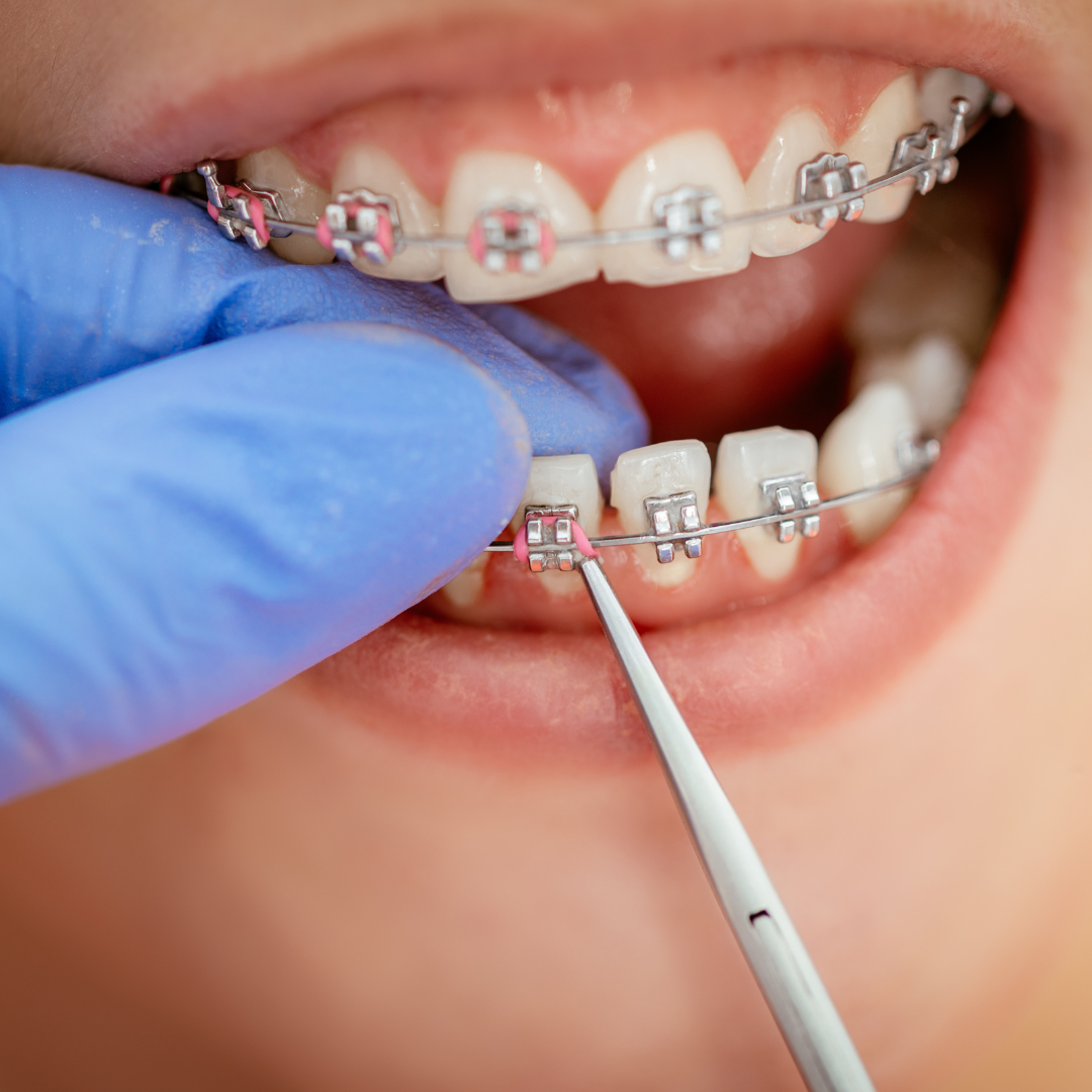 Fixing braces