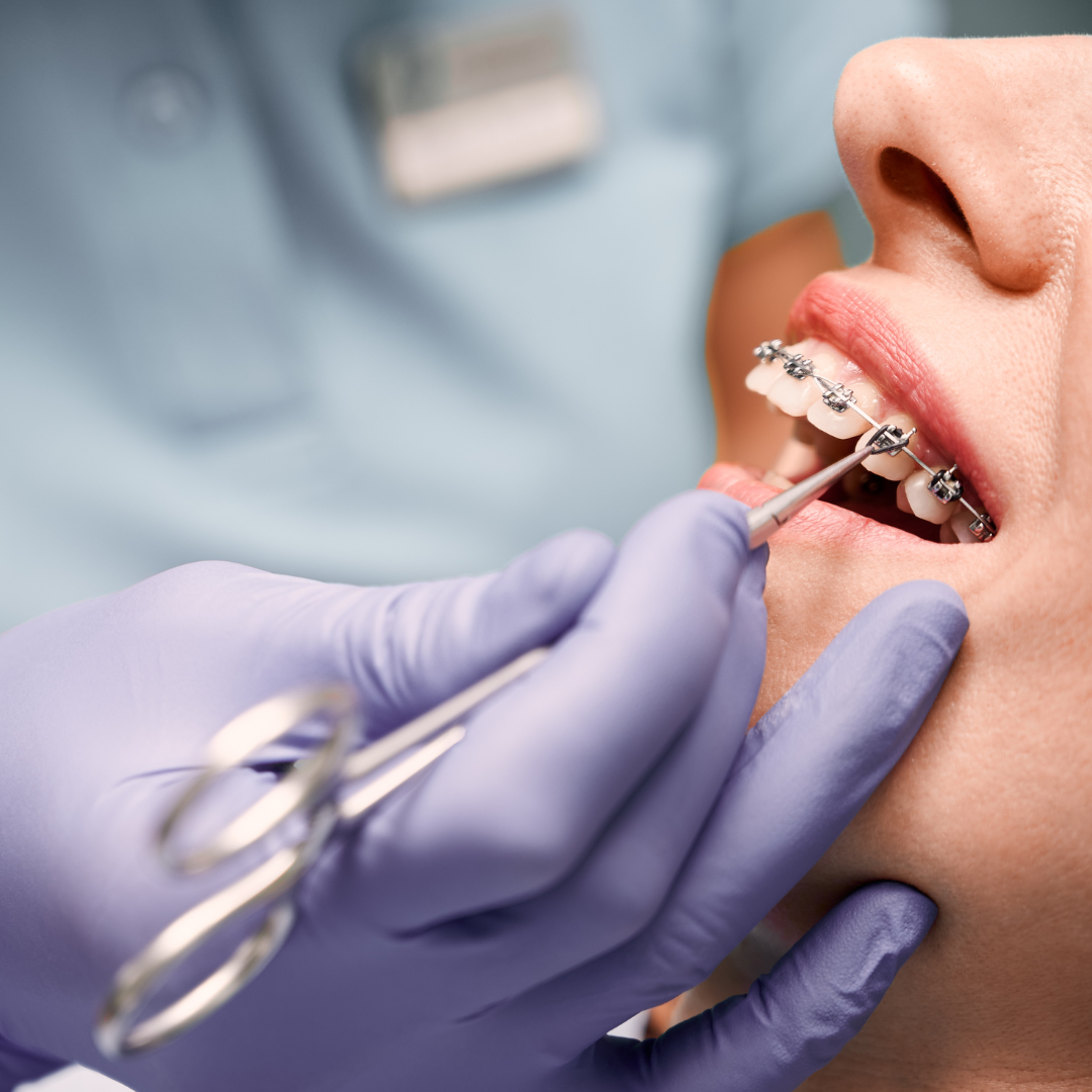 placing braces