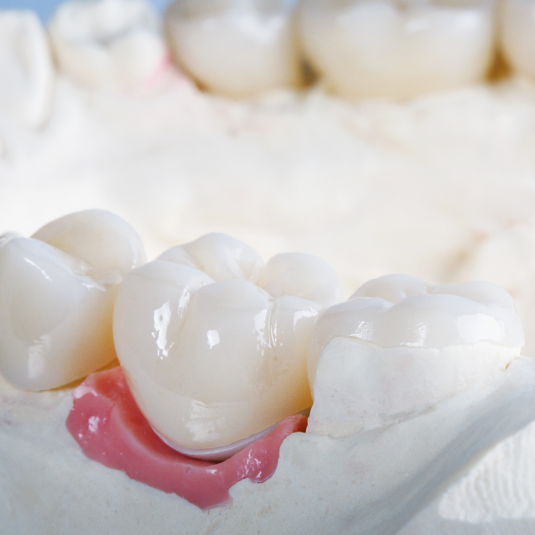 dental crown example