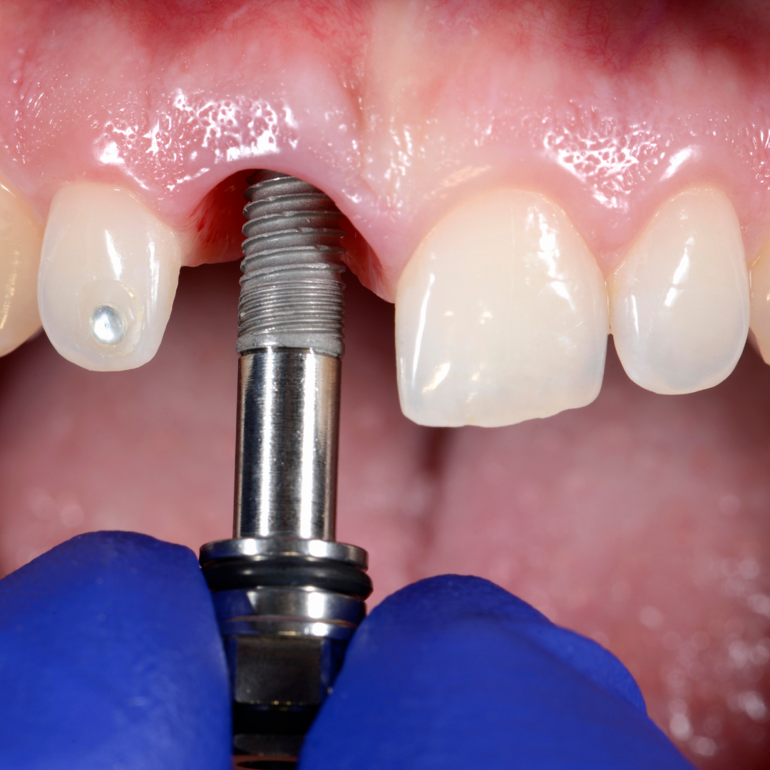 Dental Implants placement