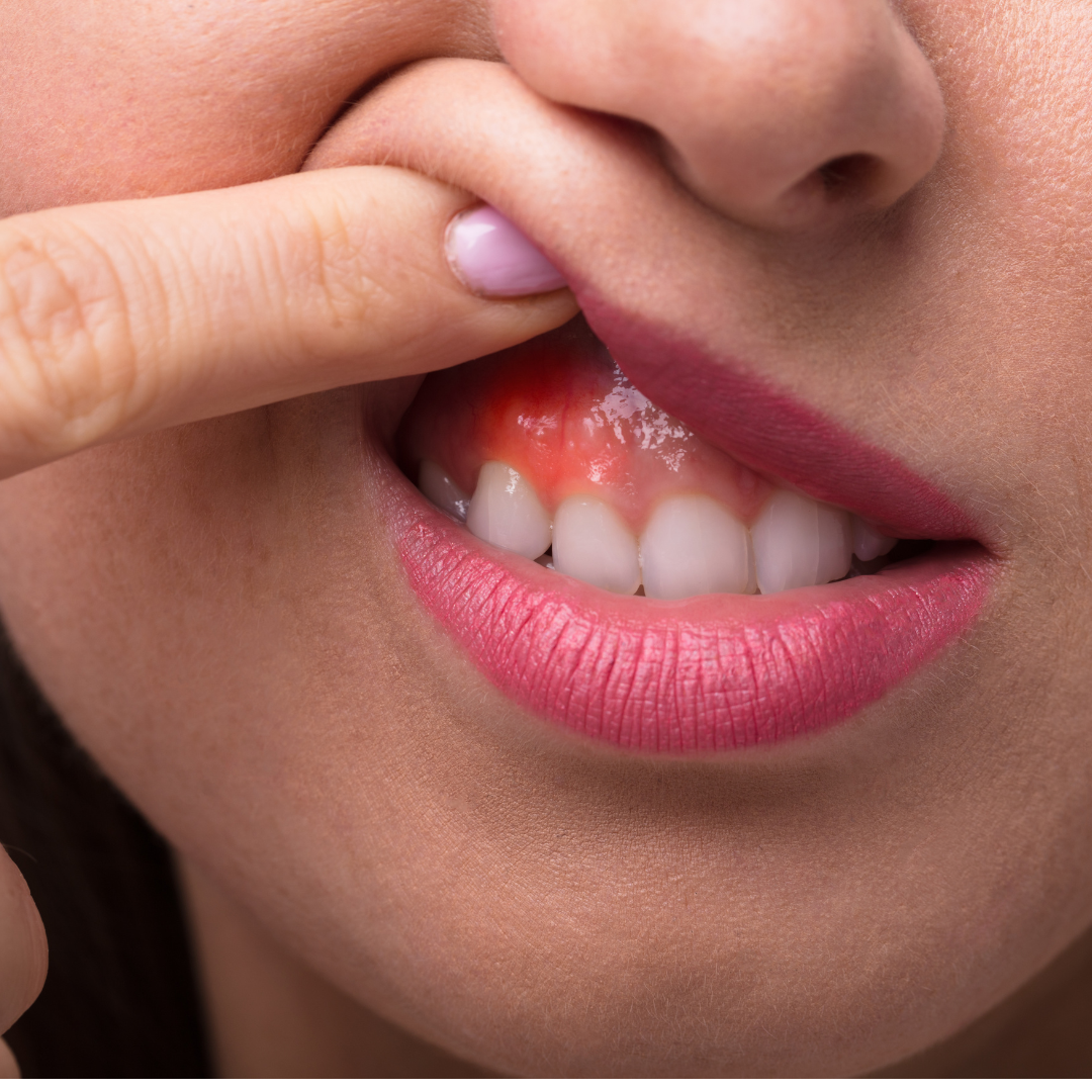 Gum Disease showcase