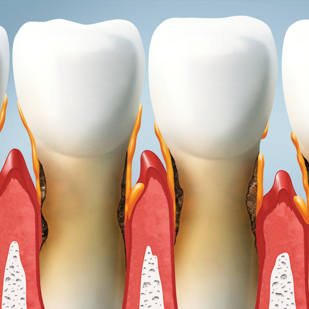 Gum Disease graphic