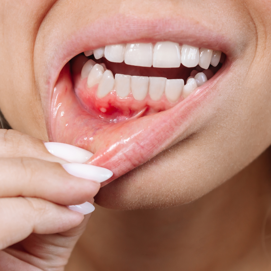 A woman showcasing gum disease