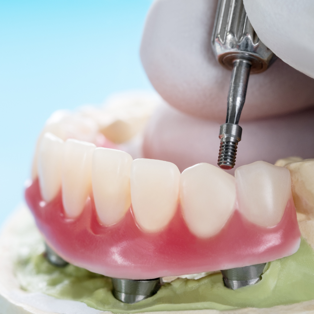 implant dentures example