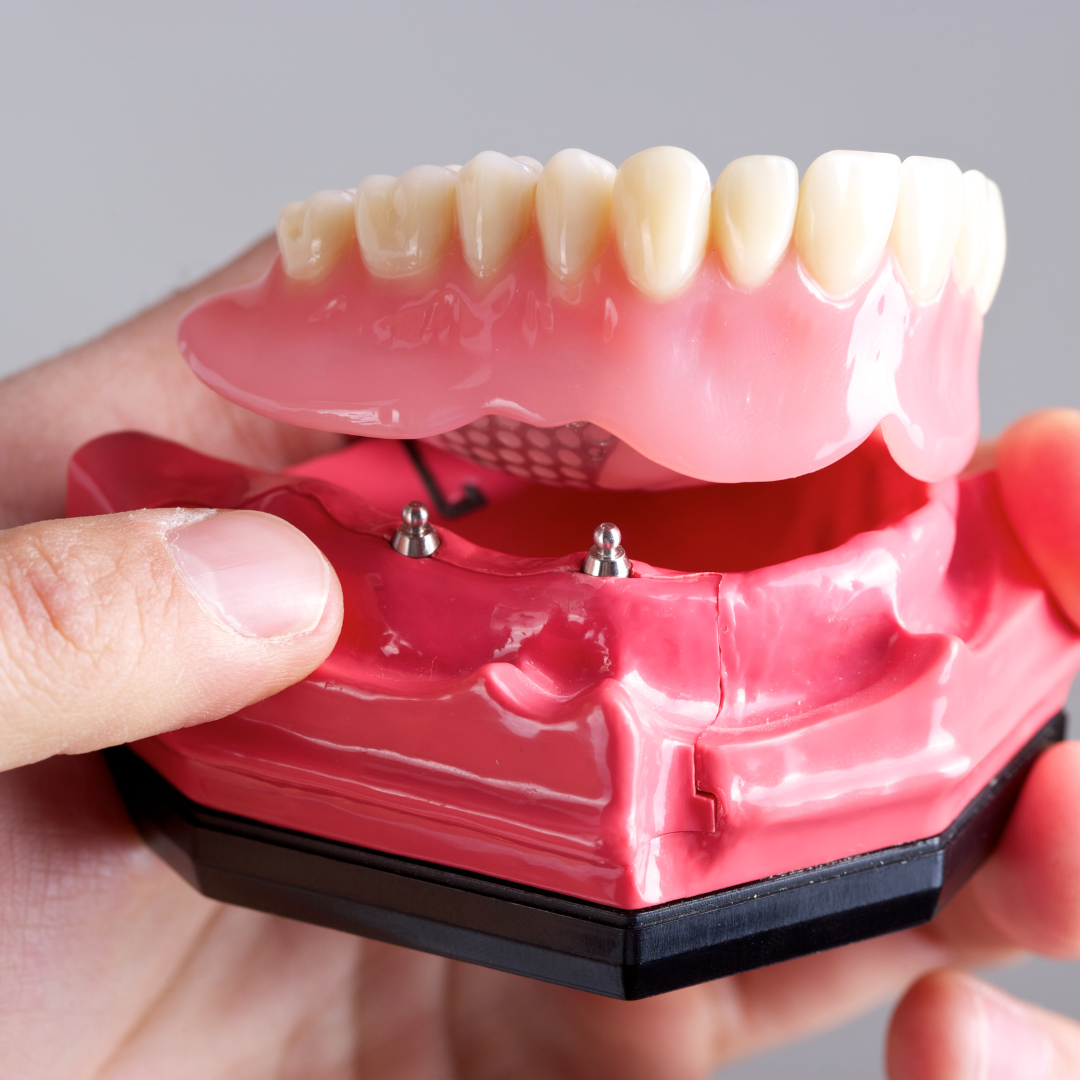 implant dentures example