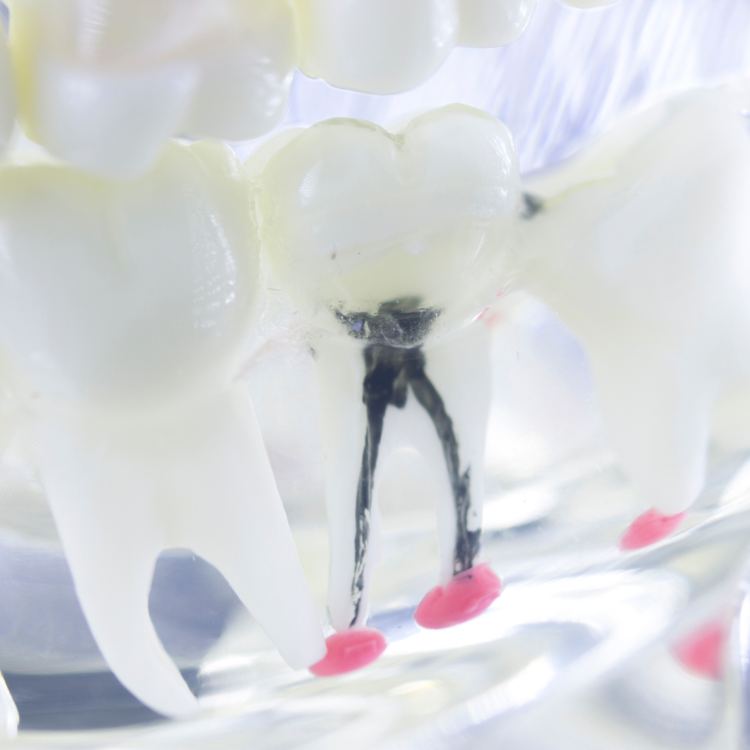 a root canal photo