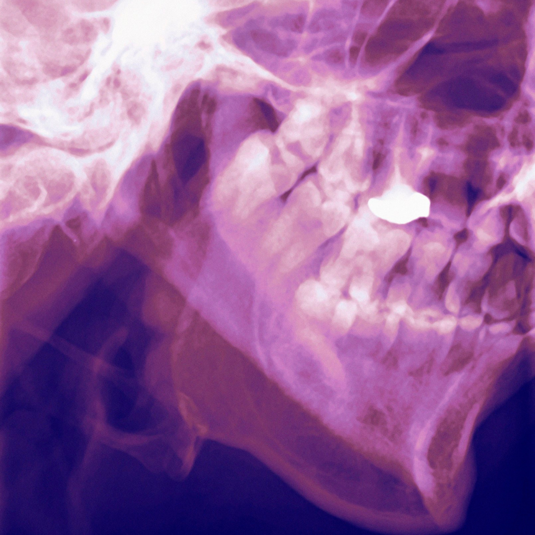 TMJ X-ray