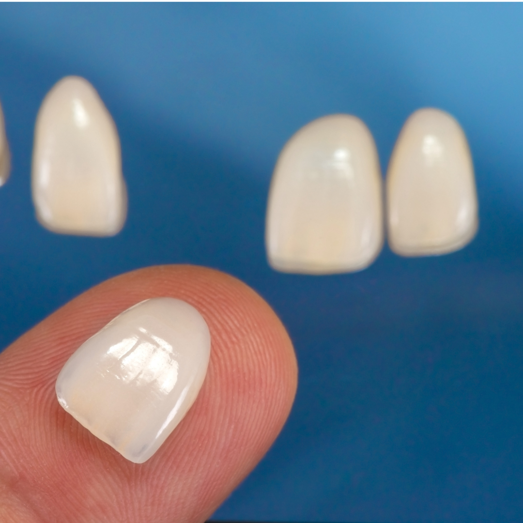 Veneers example