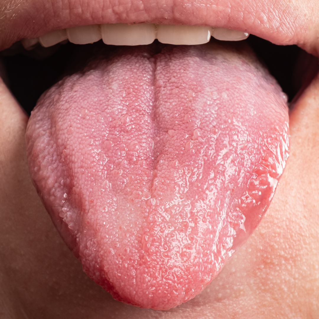 oral cancer screening