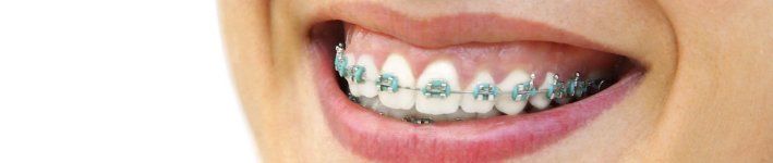 Braces — Fresno, CA — Donald E. Snyder Orthodontics