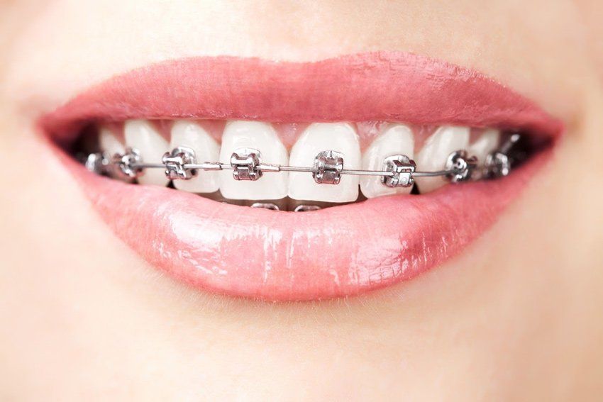 Orthodontic Specialist — Teeth with Braces in Fresno, CA